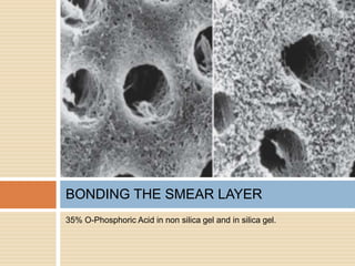 35% O-Phosphoric Acid in non silica gel and in silica gel.
BONDING THE SMEAR LAYER
 