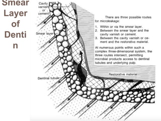 Smear
Layer
of
Denti
n
 