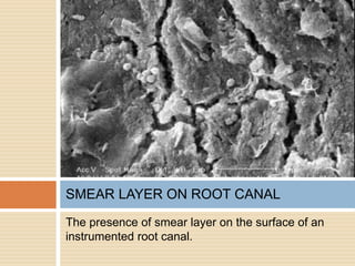 The presence of smear layer on the surface of an
instrumented root canal.
SMEAR LAYER ON ROOT CANAL
 