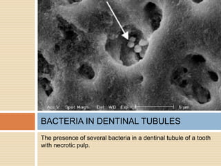 The presence of several bacteria in a dentinal tubule of a tooth
with necrotic pulp.
BACTERIA IN DENTINAL TUBULES
 