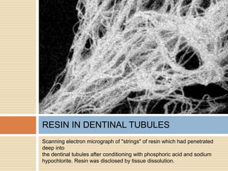 Scanning electron micrograph of "strings" of resin which had penetrated
deep into
the dentinal tubules after conditioning with phosphoric acid and sodium
hypochlorite. Resin was disclosed by tissue dissolution.
RESIN IN DENTINAL TUBULES
 