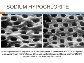 SODIUM HYPOCHLORITE
Scanning electron micrographs show dentin etched for 10 seconds with 50% phosphoric
acid. A significant morphological difference exists following additional treatment for 60
seconds with 5.25% sodium hypochlorite.
 