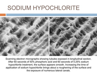 SODIUM HYPOCHLORITE
Scanning electron micrographs showing tubules exposed in longitudinal section.
After 60 seconds of 50% phosphoric acid and 60 seconds of 5.25% sodium
hypochlorite treatment, the surface appears smooth. Increasing the time of
application of sodium hypochlorite brings about a roughening of the surface and
the exposure of numerous lateral canals.
 
