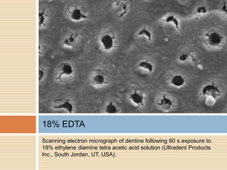 Scanning electron micrograph of dentine following 60 s exposure to
18% ethylene diamine tetra acetic acid solution (Ultradent Products
Inc., South Jordan, UT, USA).
18% EDTA
 