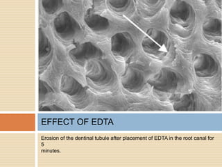 Erosion of the dentinal tubule after placement of EDTA in the root canal for
5
minutes.
EFFECT OF EDTA
 