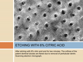 After etching with 6% citric acid and for two minutes. The orifices of the
patent dentinal tubules are flared due to removal of peritubular dentin.
Scanning electron micrograph.
ETCHING WITH 6% CITRIC ACID
 
