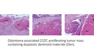 The so called Calcifying Odontogenic Cyst (Doctor Faris Alabeedi MSc ...
