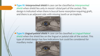 Type IV: Interproximal shield A case can be classified as interproximal
shield when shield lies only in mesial r distal part of the socket. This
design is indicated when there is buccal bone resorption requiring graft,
and there is an adjacent side with missing tooth or an implant.
Type V: Lingual-palatal shield A case can be classified as Lingual-Palatal
shield when the shield lies on the lingual or palatal side of the socket. This
type of shield design has few indications but could be considered for
maxillary molar.
 