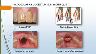 PROCEDURE OF SOCKET SHIELD TECHNIQUE:
A case of VRF Root sectioning done
Palatal portion of root removedPrepared socket shield
 