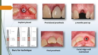 Implant placed Provisional prosthesis 3 months post op
Facial ridge well
maintained
Final prosthesisBurs for technique
 