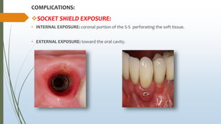 COMPLICATIONS:
SOCKET SHIELD EXPOSURE:
• INTERNAL EXPOSURE: coronal portion of the S-S perforating the soft tissue.
• EXTERNAL EXPOSURE: toward the oral cavity.
 