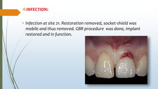 INFECTION:
• Infection at site 21. Restoration removed, socket-shield was
mobile and thus removed. GBR procedure was done, implant
restored and in function.
 