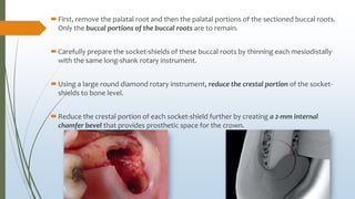 First, remove the palatal root and then the palatal portions of the sectioned buccal roots.
Only the buccal portions of the buccal roots are to remain.
Carefully prepare the socket-shields of these buccal roots by thinning each mesiodistally
with the same long-shank rotary instrument.
Using a large round diamond rotary instrument, reduce the crestal portion of the socket-
shields to bone level.
Reduce the crestal portion of each socket-shield further by creating a 2-mm internal
chamfer bevel that provides prosthetic space for the crown.
 