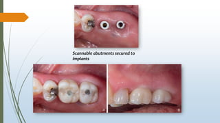 Scannable abutments secured to
implants
 