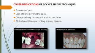 CONTRAINDICATIONS OF SOCKET SHIELD TECHNIQUE:
Presence of pus.
Lack of bone beyond the apex.
Close proximity to anatomical vital structures.
Clinical conditions preventing primary closure.
 
