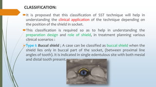 CLASSIFICATION:
It is proposed that this classification of SST technique will help in
understanding the clinical application of the technique depending on
the position of the shield in socket.
This classification is required so as to help in understanding the
preparation design and role of shield, in treatment planning various
clinical scenarios :
Type I: Buccal shield ; A case can be classified as buccal shield when the
shield lies only in buccal part of the socket, (between proximal line
angles of tooth). It is indicated in single edentulous site with both mesial
and distal tooth present.
 