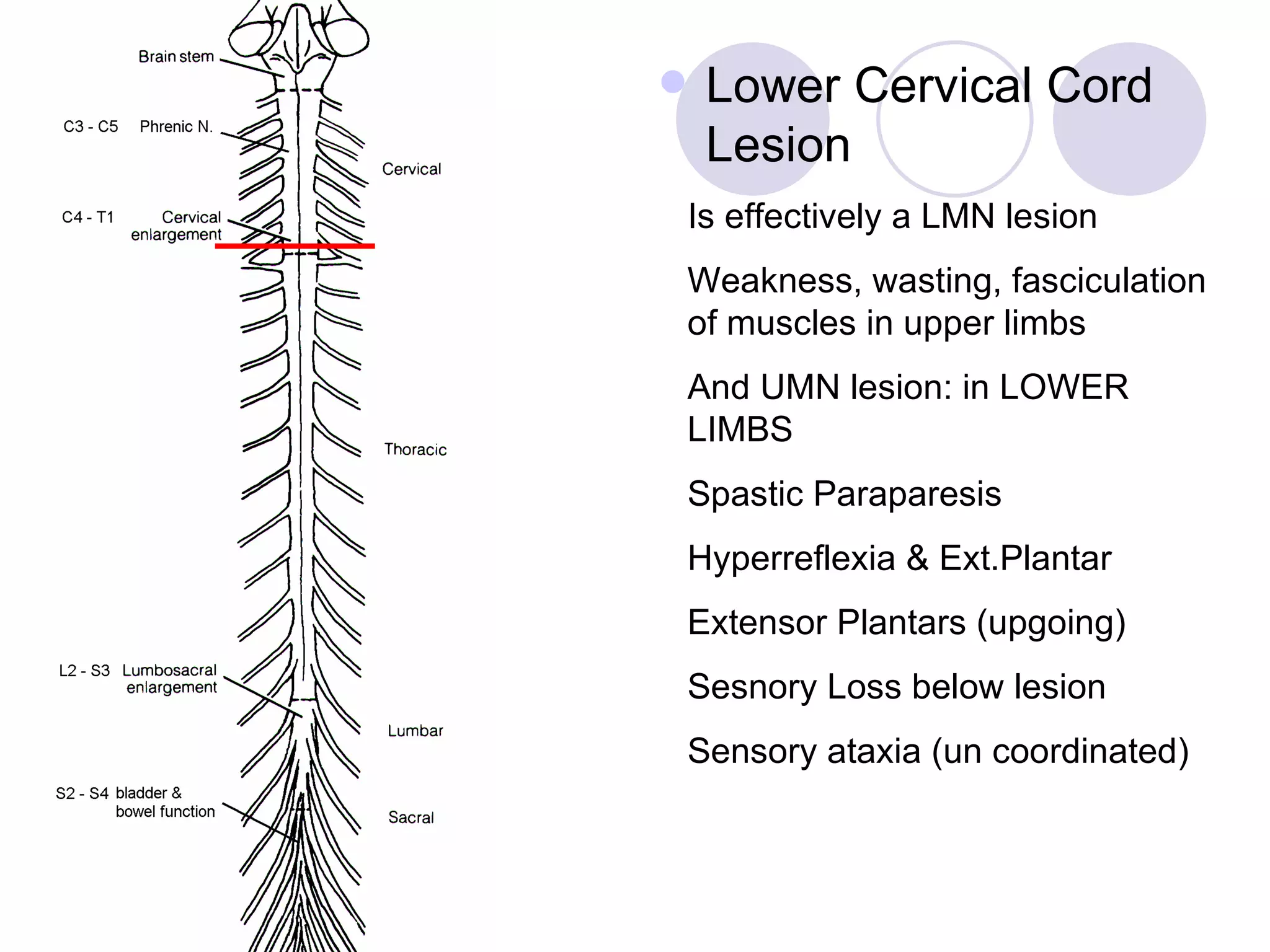 Lower Cervical Cord Lesion Is effectively a LMN lesion Weakness, wasting, fasciculation of muscles in upper limbs And UMN lesion: in LOWER LIMBS Spastic Paraparesis Hyperreflexia & Ext.Plantar  Extensor Plantars (upgoing) Sesnory Loss below lesion Sensory ataxia (un coordinated) 