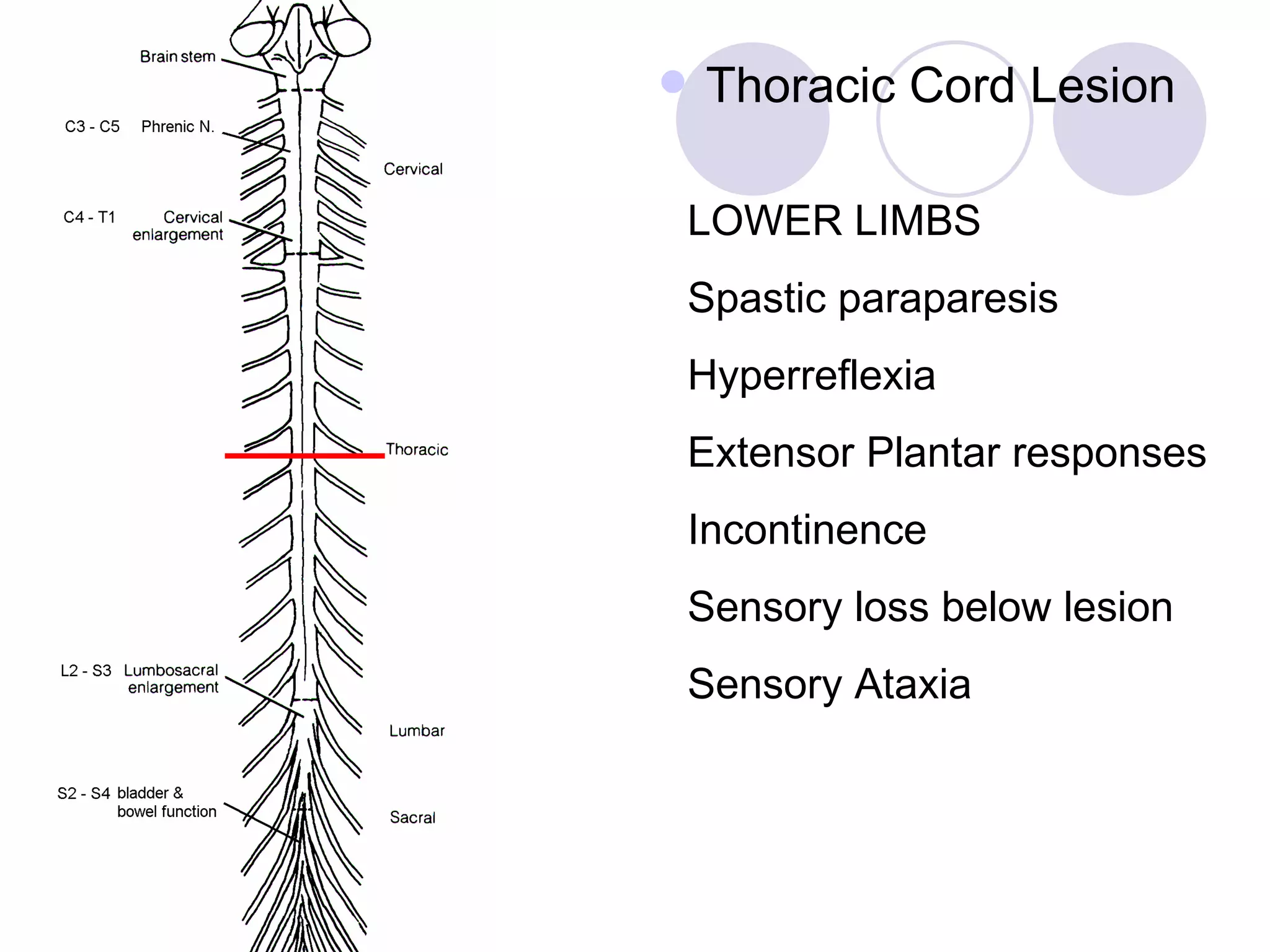 Thoracic Cord Lesion LOWER LIMBS Spastic paraparesis Hyperreflexia Extensor Plantar responses Incontinence Sensory loss below lesion Sensory Ataxia 