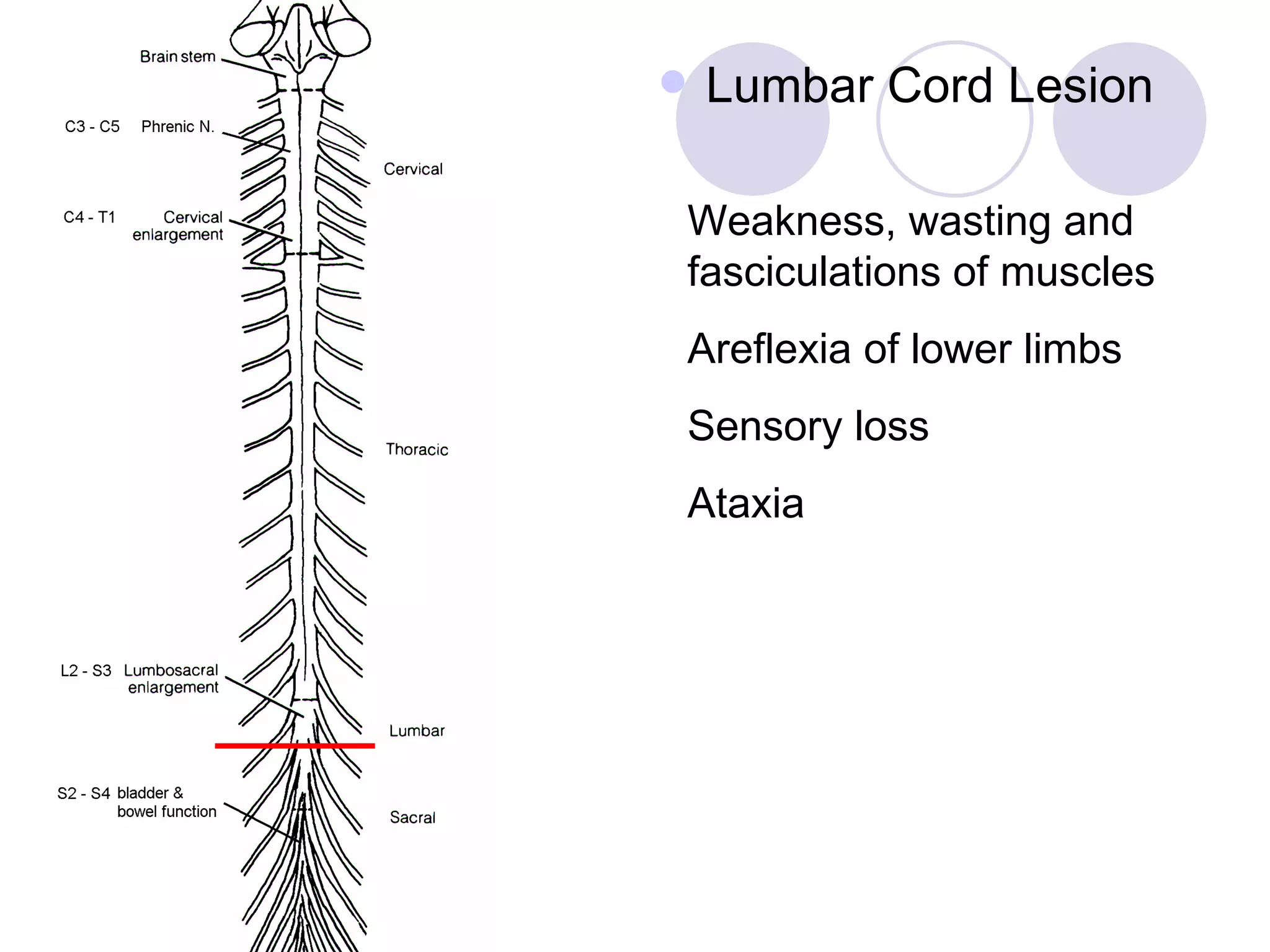 Lumbar Cord Lesion Weakness, wasting and fasciculations of muscles Areflexia of lower limbs Sensory loss Ataxia 