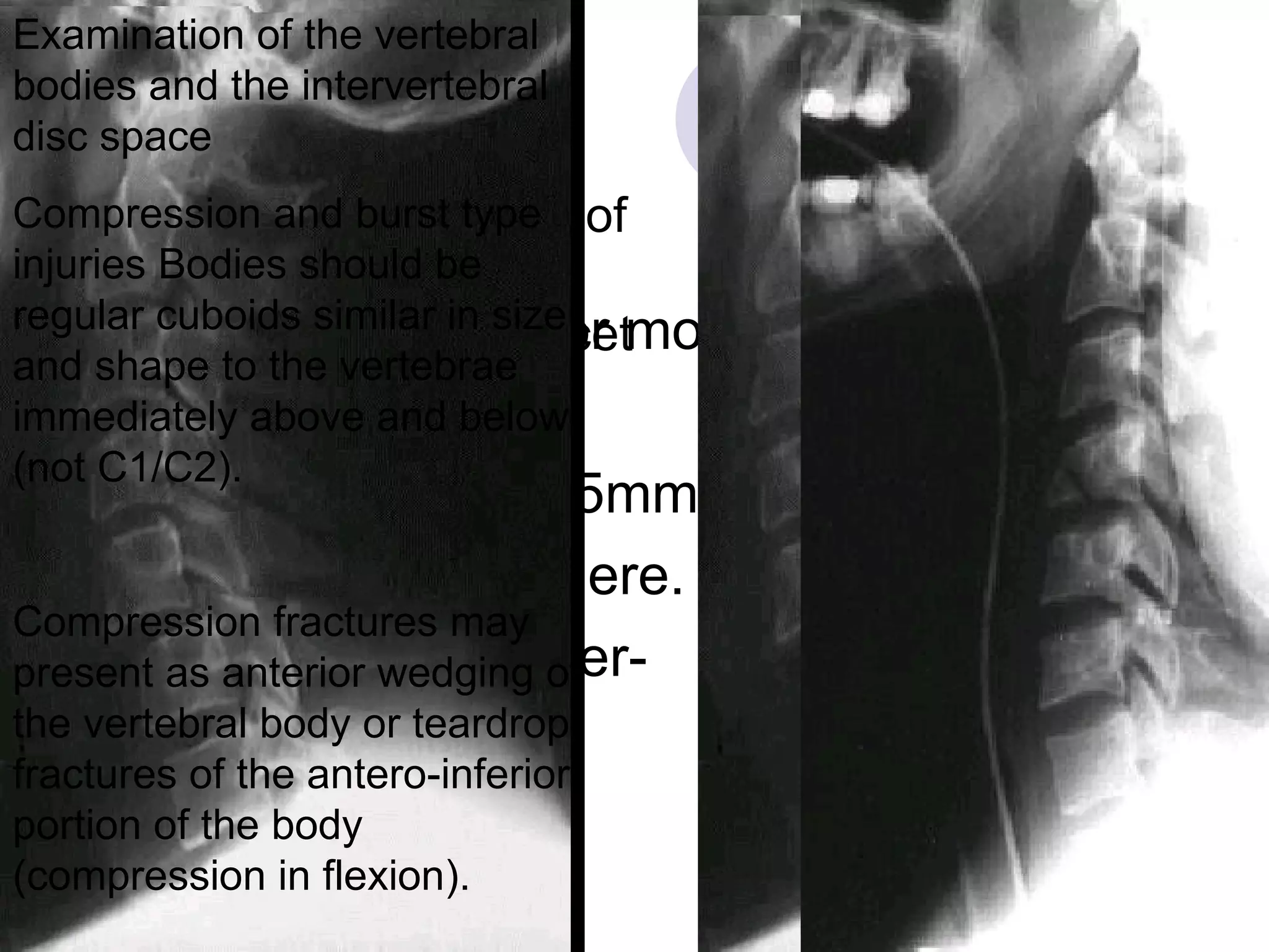 Radiology Lateral: C7-T1 junction Alignment: Posterior more significant than ant. A translation of > 3.5mm is significant anywhere.  Spinal canal diameter-  >18mm  Anterior subluxation of one vertebra on another indicates facet dislocation.  Examination of the vertebral bodies and the intervertebral disc space Compression and burst type injuries Bodies should be regular cuboids similar in size and shape to the vertebrae immediately above and below (not C1/C2). Compression fractures may present as anterior wedging of the vertebral body or teardrop fractures of the antero-inferior portion of the body (compression in flexion).  