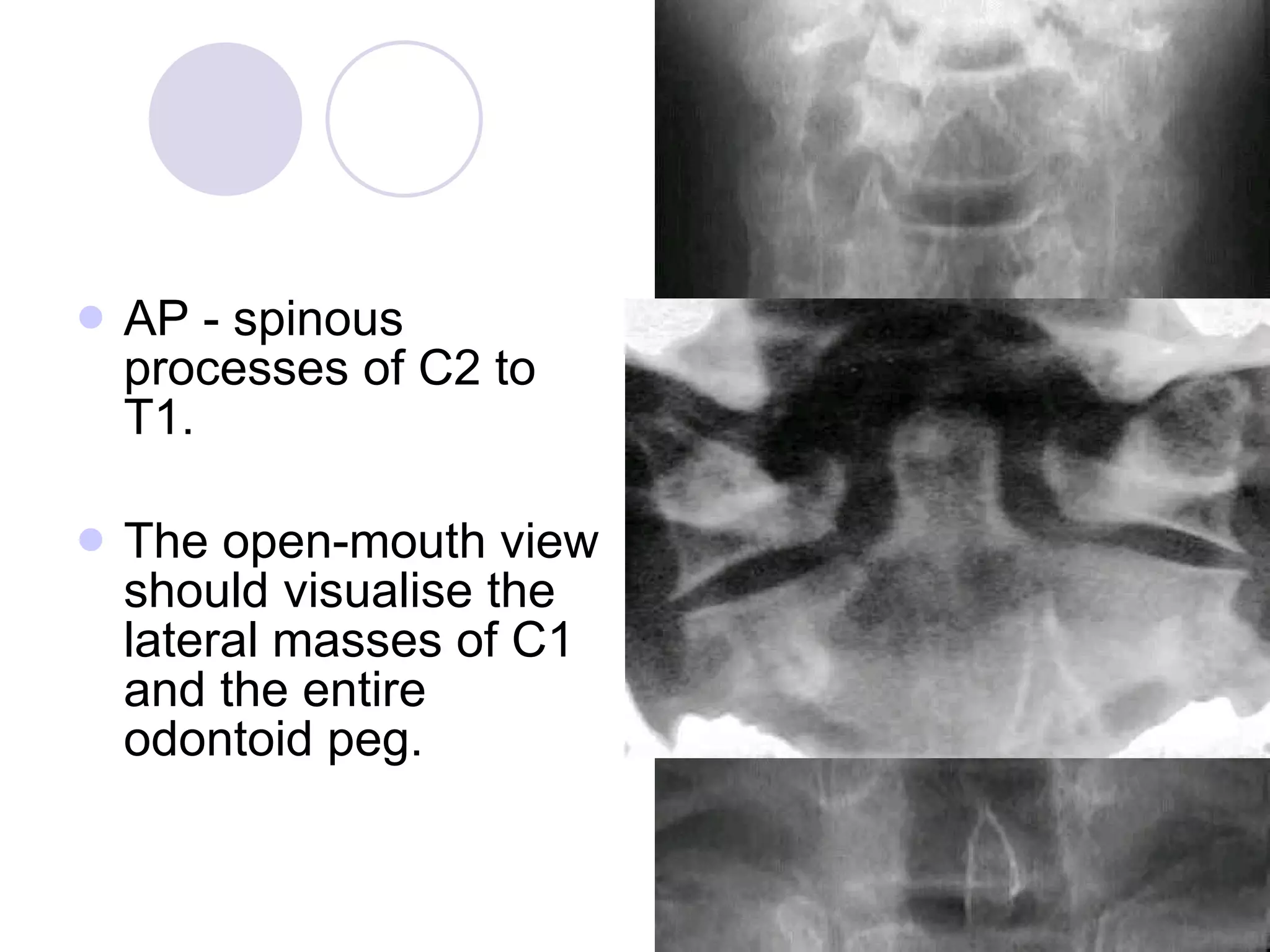 AP - spinous processes of C2 to T1.  The open-mouth view should visualise the lateral masses of C1 and the entire odontoid peg.  