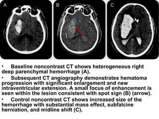 • Baseline noncontrast CT shows heterogeneous right
deep parenchymal hemorrhage (A).
• Subsequent CT angiography demonstrates hematoma
progression with significant enlargement and new
intraventricular extension. A small focus of enhancement is
seen within the lesion consistent with spot sign (B) (arrow).
• Control noncontrast CT shows increased size of the
hemorrhage with substantial mass effect, subfalcine
herniation, and midline shift (C).
 