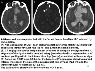 22
A 64-year-old woman presented with the ‘worst headache of her life’ followed by
obtundation.
(A) Non-contrast CT (NCCT) scan showing a left inferior frontal ICH (24.8 ml) with
associated intraventricular hge (55 ml) and SAH in the basal cisterns.
(B) CT angiogram source image in spot windows showing an aneurysm of the A2
segment of the right anterior cerebral artery (arrowhead) with a separate focus of
contrast pooling within the intracerebral hge (arrow), consistent with a spot sign.
(C) Follow-up NCCT scan 3.5 h after the baseline CT angiogram showing marked
interval increase in the size of the intracerebral hemorrhage (72.6 ml) and the
intraventricular hemorrhage (215.2 ml).
The patient died shortly after the follow-up NCCT scan.
 