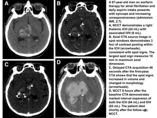 23
A 67-year-old man on warfarin
therapy for atrial fibrillation and
daily aspirin intake presents
with syncope and increasing
unresponsiveness (admission
INR, 2.7).
A, NCCT demonstrates a right
thalamic ICH (24 mL) with
associated IVH (6 mL).
B, Axial CTA source image in
spot windows demonstrates 3
foci of contrast pooling within
the ICH (arrowheads),
consistent with spot signs. The
largest spot sign measures 10
mm in maximum axial
dimension.
C, Delayed CTA acquisition 48
seconds after the first-pass
CTA shows that the spot signs
increased in volume and
changed in morphology
(arrowheads).
D, NCCT 8 hours after the
baseline CTA demonstrates
marked interval expansion of
both the ICH (94 mL) and IVH
(82 mL). The patient died
shortly after the follow-up
NCCT.
 