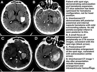 27
• Patient with spot sign,
demonstrating extravasation
and hematoma expansion.
CT slice selection has been
optimized for hematoma
configuration, not for head
position.
• A, Unenhanced CT
demonstrates left posterior
putaminal and internal
capsule hematoma with mild
surrounding edema. An old
parieto-occipital infarct is
seen posterior to this.
• B, A small focus of
enhancement is seen
peripherally on CTA source
images, consistent with the
spot sign (black arrow).
• C, Postcontrast CT
demonstrates enlargement
of the spot sign, consistent
with extravasation (white
arrow).
• D, Unenhanced CT image 1
day after presentation
reveals hematoma
enlargement and
intraventricular hemorrhage.
 