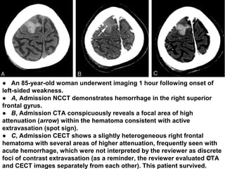 28
● An 85-year-old woman underwent imaging 1 hour following onset of
left-sided weakness.
● A, Admission NCCT demonstrates hemorrhage in the right superior
frontal gyrus.
● B, Admission CTA conspicuously reveals a focal area of high
attenuation (arrow) within the hematoma consistent with active
extravasation (spot sign).
● C, Admission CECT shows a slightly heterogeneous right frontal
hematoma with several areas of higher attenuation, frequently seen with
acute hemorrhage, which were not interpreted by the reviewer as discrete
foci of contrast extravasation (as a reminder, the reviewer evaluated CTA
and CECT images separately from each other). This patient survived.
 