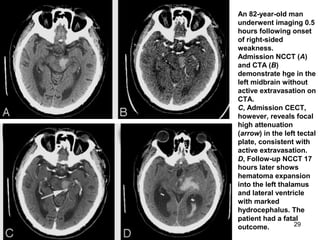 29
An 82-year-old man
underwent imaging 0.5
hours following onset
of right-sided
weakness.
Admission NCCT (A)
and CTA (B)
demonstrate hge in the
left midbrain without
active extravasation on
CTA.
C, Admission CECT,
however, reveals focal
high attenuation
(arrow) in the left tectal
plate, consistent with
active extravasation.
D, Follow-up NCCT 17
hours later shows
hematoma expansion
into the left thalamus
and lateral ventricle
with marked
hydrocephalus. The
patient had a fatal
outcome.
 