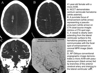 30
41-year-old female with a
micro AVM.
A, NCCT demonstrates
centrum semiovale hematoma
(white asterisk).
B, A punctate focus of
enhancement (white arrow)
representing a pseudo-
aneurysm (white arrow) on
CTA axial source images
mimics a CTA spot sign.
C, A vessel is clearly seen
extending from the lateral
ventricular surface to the
hematoma periphery and
communicates with the focal
spot of enhancement on
coronal MPR image (black
arrow).
D, AP Oblique conventional
angiographic image demons-
trates a micro AVM with pseu-
doaneurysm (black arrow) fed
by branches of the anterior
cerebral artery and draining to
the lateral ventricular vein.
* Discontinuous from normal or abnormal
vasculature adjacent to the ICH
 