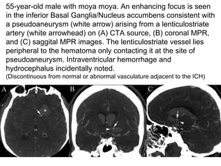 31
55-year-old male with moya moya. An enhancing focus is seen
in the inferior Basal Ganglia/Nucleus accumbens consistent with
a pseudoaneurysm (white arrow) arising from a lenticulostriate
artery (white arrowhead) on (A) CTA source, (B) coronal MPR,
and (C) saggital MPR images. The lenticulostriate vessel lies
peripheral to the hematoma only contacting it at the site of
pseudoaneurysm. Intraventricular hemorrhage and
hydrocephalus incidentally noted.
(Discontinuous from normal or abnormal vasculature adjacent to the ICH)
 