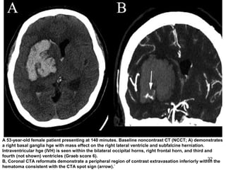 32
A 53-year-old female patient presenting at 140 minutes. Baseline noncontrast CT (NCCT; A) demonstrates
a right basal ganglia hge with mass effect on the right lateral ventricle and subfalcine herniation.
Intraventricular hge (IVH) is seen within the bilateral occipital horns, right frontal horn, and third and
fourth (not shown) ventricles (Graeb score 6).
B, Coronal CTA reformats demonstrate a peripheral region of contrast extravasation inferiorly within the
hematoma consistent with the CTA spot sign (arrow).`
 