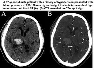 34
A 67-year-old male patient with a history of hypertension presented with
blood pressure of 200/100 mm Hg and a right thalamic intracerebral hge
on noncontrast head CT (A). (B) CTA revealed no CTA spot sign.
 