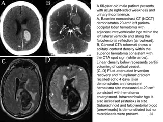 35
A 66-year-old male patient presents
with acute right-sided weakness and
urinary incontinence.
A, Baseline noncontrast CT (NCCT)
demonstrates 20-cm3
left parieto-
occipital lobar hematoma with
adjacent intraventricular hge within the
left lateral ventricle and along the
falcotentorial reflection (arrowhead).
B, Coronal CTA reformat shows a
solitary contrast density within the
superior hematoma consistent with
the CTA spot sign (white arrow).
Linear density below represents partial
voluming of cortical vessel.
(C–D) Fluid-attenuated inversion
recovery and multiplanar gradient
recalled echo 4 days later
demonstrates an increase in
hematoma size measured at 29 cm3
consistent with hematoma
enlargement. Intraventricular hge is
also increased (asterisk) in size.
Subarachnoid and falcotentorial blood
(arrowheads) is demonstrated but no
microbleeds were present.
C
 