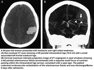 36
A 44-year-old woman presented with headache and right sided weakness.
(A) Non-contrast CT scan showing a left parietal intracerebral hge (18.4 ml) with a small
associated left frontal subdural hge.
(B) Coronal maximum intensity projection image of CT angiogram in spot windows showing
a left parietal arteriovenous fistula (arrowheads) with a separate small focus of contrast
pooling within the intracerebral hge (arrow), consistent with a spot sign. The patient
underwent endovascular embolization of the arteriovenous fistula and was discharged home
9 days after admission.
 