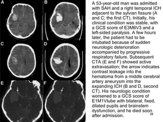 38
A 53-year-old man was admitted
with SAH and a right temporal ICH
adjacent to the sylvian fissure (A
and C; the first CT). Initially, his
clinical condition was stable, with
a GCS score of E3M6V3 and a
left-sided paralysis. A few hours
later, the patient had to be
intubated because of sudden
neurologic deterioration
accompanied by progressive
respiratory failure. Subsequent
CTA (E and F) showed active
extravasation; the arrow indicates
contrast leakage into the
hematoma from a middle cerebral
artery aneurysm into the
expanding ICH (B and D, second
CT). His neurologic condition
worsened to a GCS score of
E1M1Vtube with bilateral, fixed,
dilated pupils and brainstem
dysfunction, and he died soon
after admission.
 
