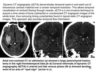 39
Axial non-contrast CT on admission (a) showed a large parenchymal haema-
toma in the right frontotemporal lobe.(b–d) Coronal reformats of dynamic CT
angiography (dCTA) in arterial and late venous phase (44 s) showed develop-
ment of an area of ‘‘spot sign’’ (arrow in c).
a b C
Dynamic CT angiography (dCTA) demonstrates temporal wash-in and wash-out of
intravenous contrast material over a chosen temporal resolution. This allows temporal
visualisation of contrast flowing through vessels. dCTA is a non-invasive technique to
acquire a time series of bone subtracted or unsubtracted CT angiogram images of the
whole brain, thus removing timing uncertainties found in typical static CT angiogram
images. This approach also provides temporal flow information.
 