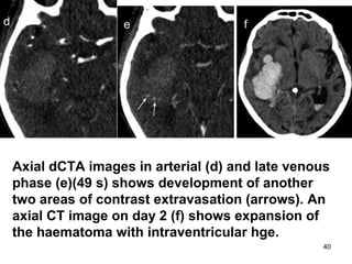 40
Axial dCTA images in arterial (d) and late venous
phase (e)(49 s) shows development of another
two areas of contrast extravasation (arrows). An
axial CT image on day 2 (f) shows expansion of
the haematoma with intraventricular hge.
d e f
 