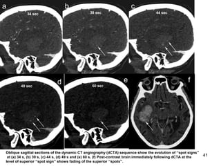 41
Oblique sagittal sections of the dynamic CT angiography (dCTA) sequence show the evolution of ‘‘spot signs’’
at (a) 34 s, (b) 39 s, (c) 44 s, (d) 49 s and (e) 60 s. (f) Post-contrast brain immediately following dCTA at the
level of superior ‘‘spot sign’’ shows fading of the superior ‘‘spots’’.
a b c
d e f
 