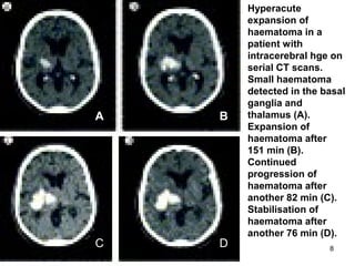 8
• Hyperacute
expansion of
haematoma in a
patient with
intracerebral hge on
serial CT scans.
Small haematoma
detected in the basal
ganglia and
thalamus (A).
Expansion of
haematoma after
151 min (B).
Continued
progression of
haematoma after
another 82 min (C).
Stabilisation of
haematoma after
another 76 min (D).
A B
C D
 