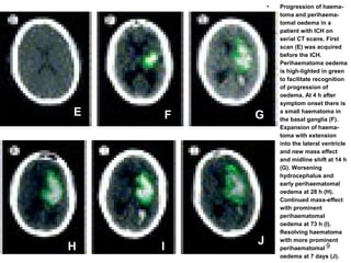 9
• Progression of haema-
toma and perihaema-
tomal oedema in a
patient with ICH on
serial CT scans. First
scan (E) was acquired
before the ICH.
Perihaematoma oedema
is high-lighted in green
to facilitate recognition
of progression of
oedema. At 4 h after
symptom onset there is
a small haematoma in
the basal ganglia (F).
Expansion of haema-
toma with extension
into the lateral ventricle
and new mass effect
and midline shift at 14 h
(G). Worsening
hydrocephalus and
early perihaematomal
oedema at 28 h (H).
Continued mass-effect
with prominent
perihaematomal
oedema at 73 h (I).
Resolving haematoma
with more prominent
perihaematomal
oedema at 7 days (J).
E F G
H I
J
 
