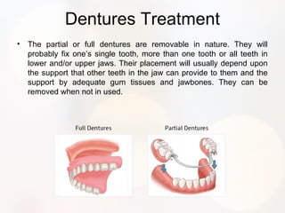 Dentures Treatment
• The partial or full dentures are removable in nature. They will
probably fix one’s single tooth, more than one tooth or all teeth in
lower and/or upper jaws. Their placement will usually depend upon
the support that other teeth in the jaw can provide to them and the
support by adequate gum tissues and jawbones. They can be
removed when not in used.
 