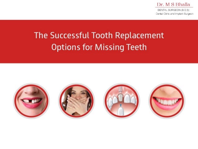Best options to replace missing teeth