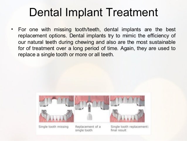 Best options to replace missing teeth