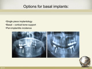 Options for basal implants:
•Single piece implantology
•Basal – cortical bone support
•Peri-implantitis incidence
 