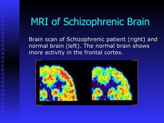 MRI of Schizophrenic Brain Brain scan of Schizophrenic patient (right) and normal brain (left). The normal brain shows more activity in the frontal cortex.  
