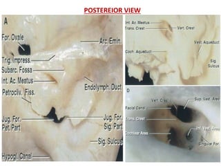 The temporal bone and transtemporal approaches | PPTX