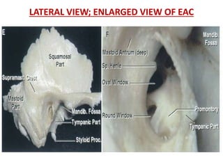 The temporal bone and transtemporal approaches | PPTX